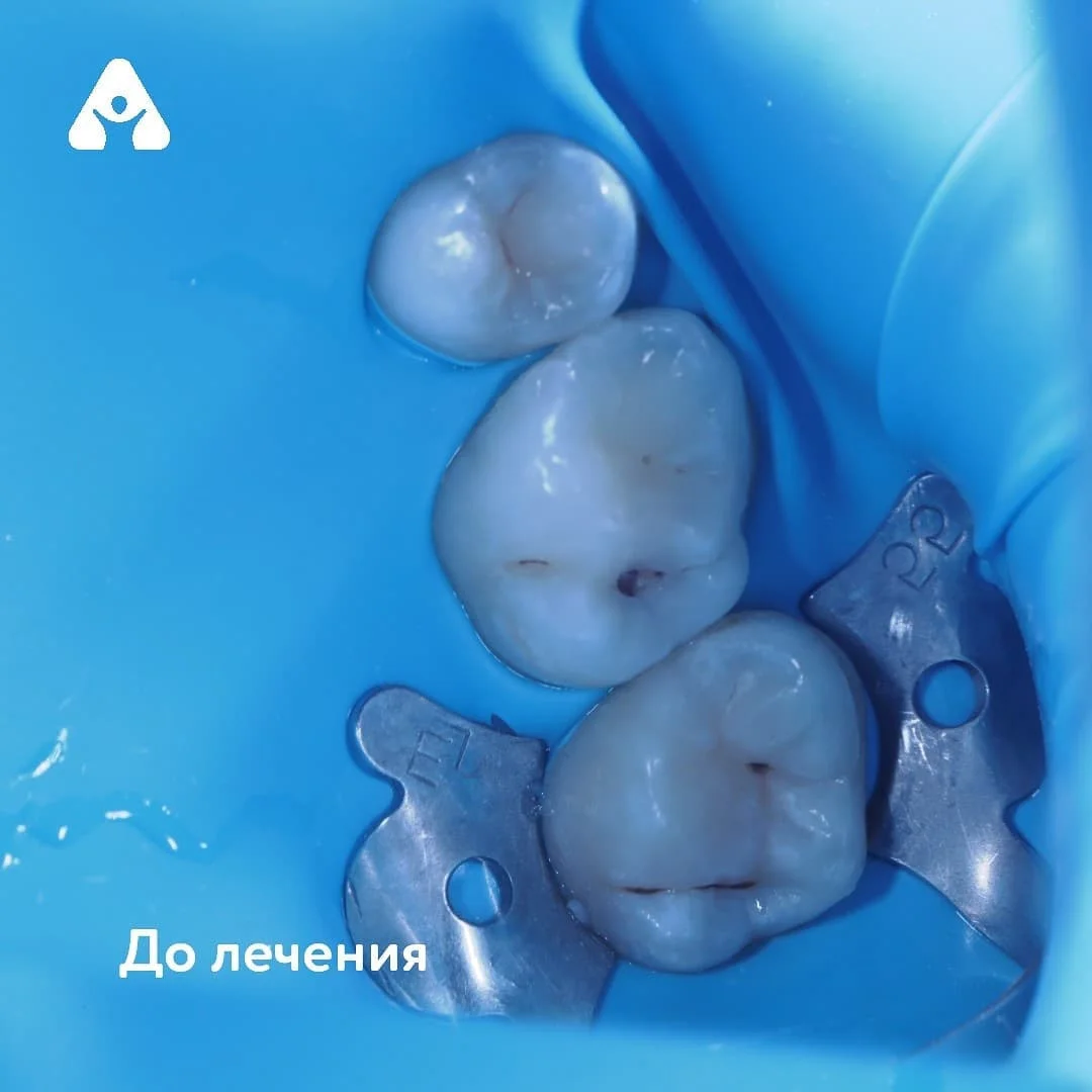 Лечение среднего кариеса зубов — до
