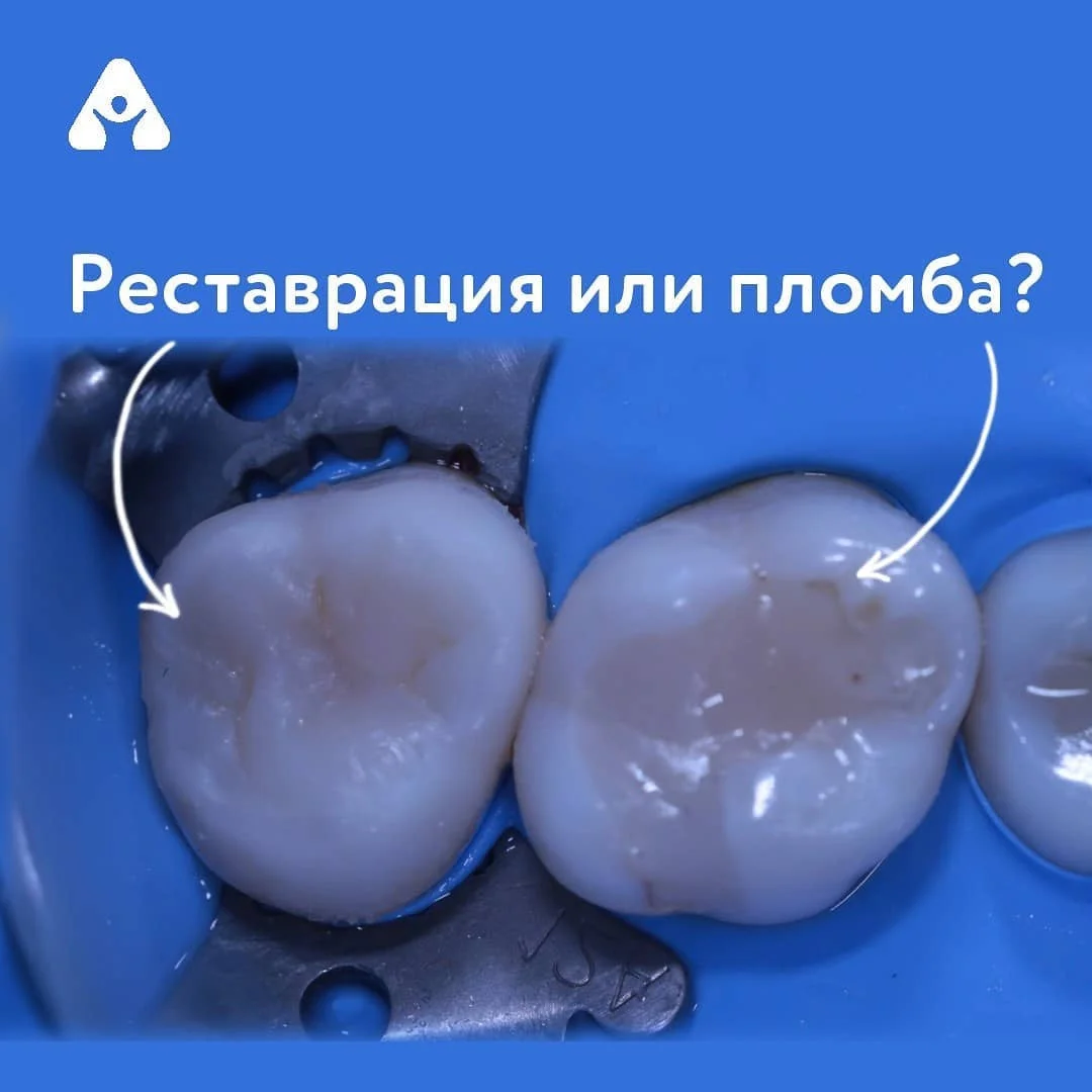 Художественная реставрация зуба — до