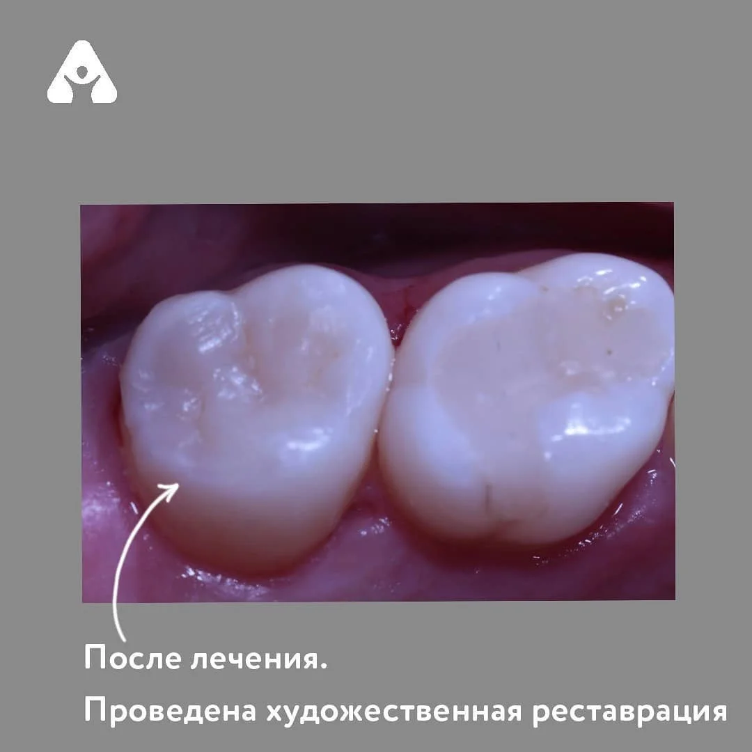Художественная реставрация зуба — после