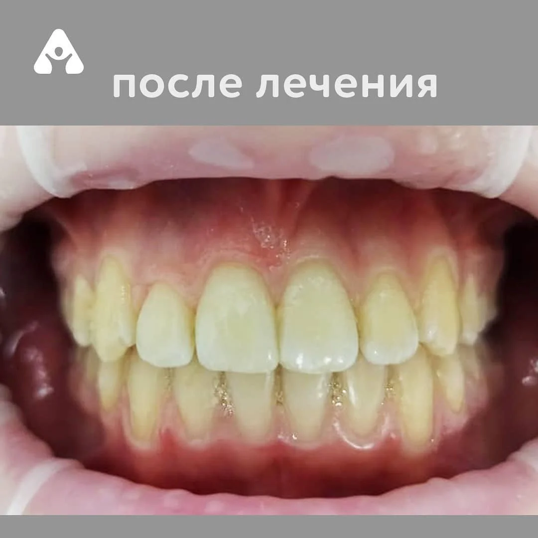 Установка брекетов — после