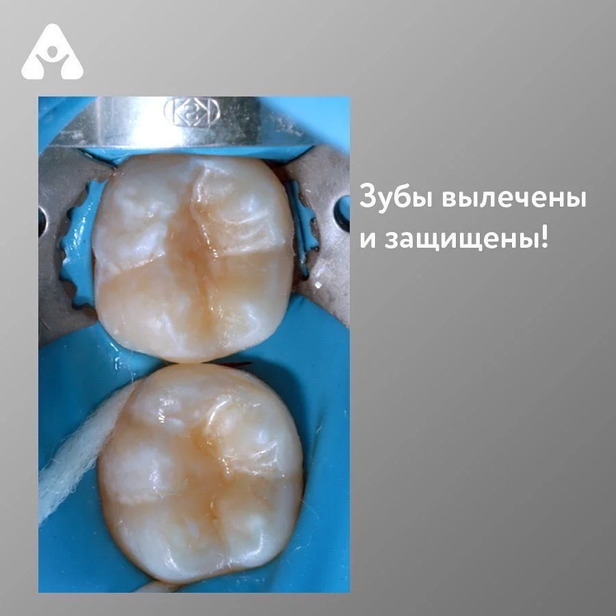 Чёрные точки на зубах — после