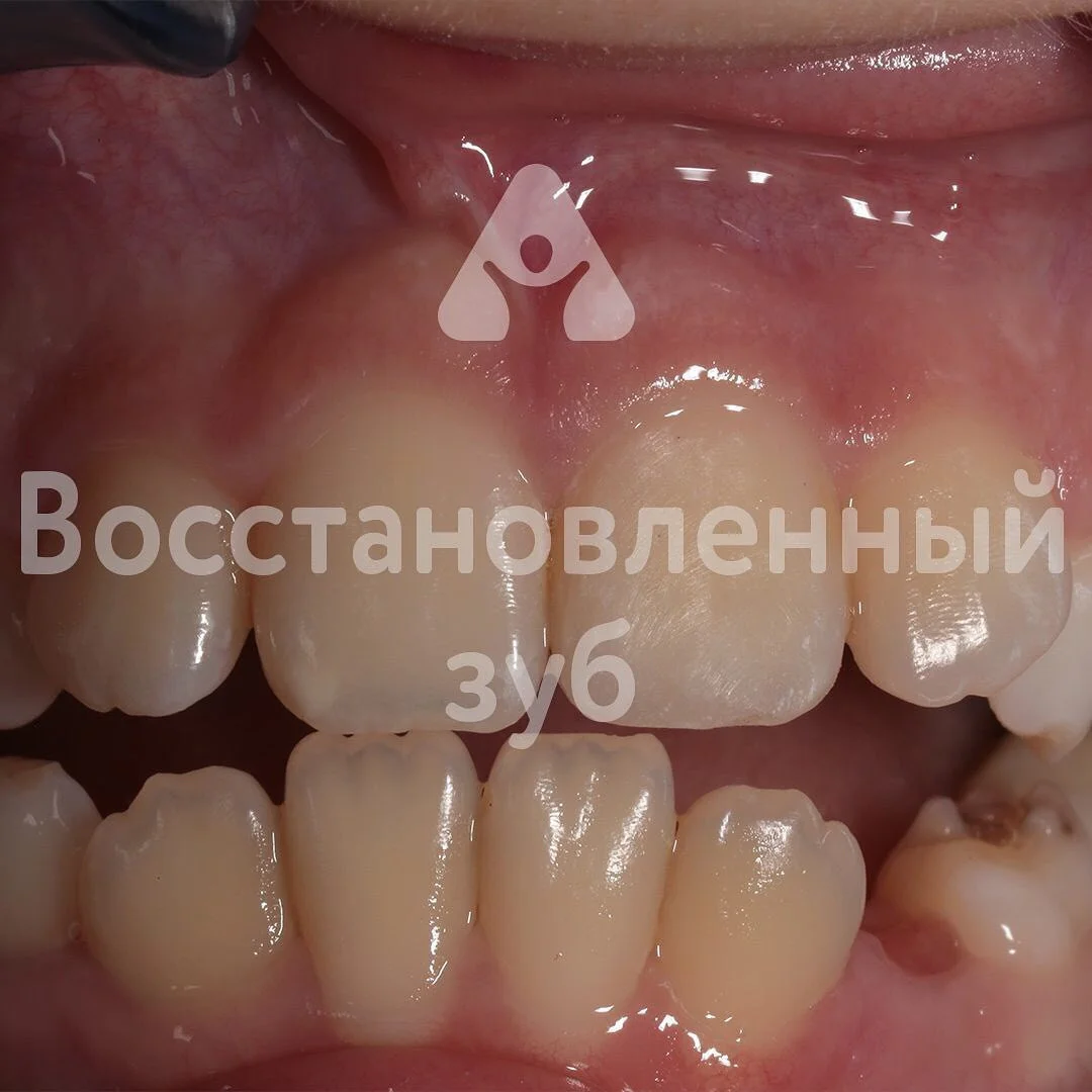 Восстановление зуба — после